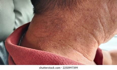 Portrait Showing Chronic Dermatitis On Neck Stock Photo 2250997399 ...