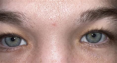 change color eyes surgery 5