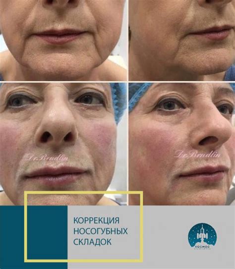 Ботулинотерапия - цена в Санкт-Петербурге
