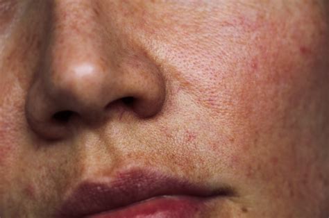 Why diet plays a role in forming blackheads around mouth 13