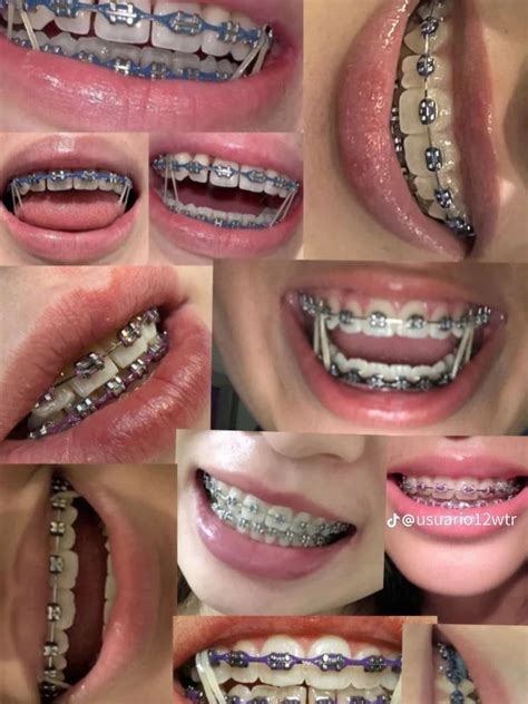 How to put rubber bands on braces – Artofit