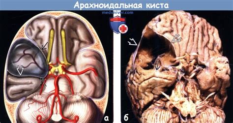 Арахноидальная киста на МРТ