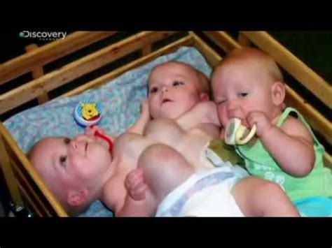 Rare Twins - Gemelli siamesi multipli - YouTube