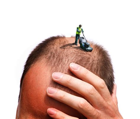 male pattern baldness | Hair advertising, Male pattern baldness, Hair