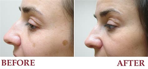 Laser Treatment For Dark Spots