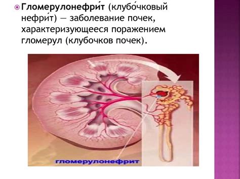 Гломерулонефрит. Тактика введения лечения у беременных. Показания к ...