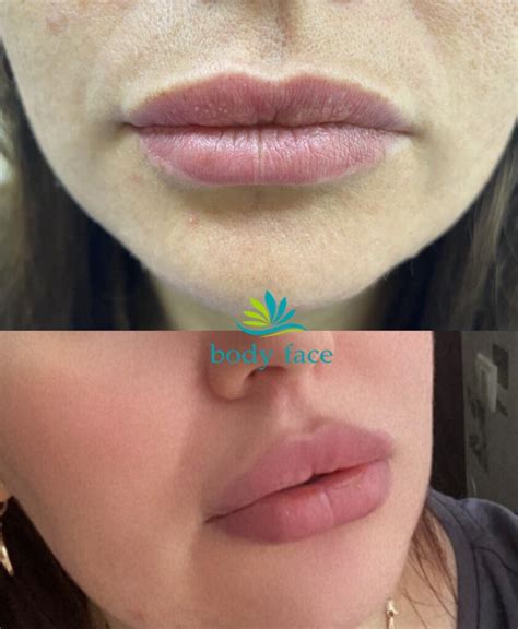 Контурная пластика губ, лица в Киеве. ТОП ЦЕНА - body-face.com.ua