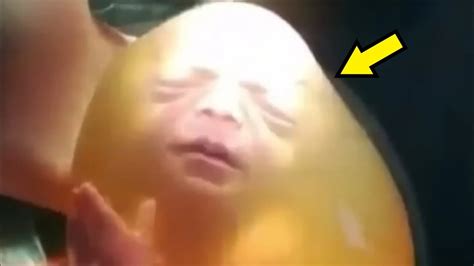 Когда врачи сделали кесарево сечение и увидели малыша, то закричали ...