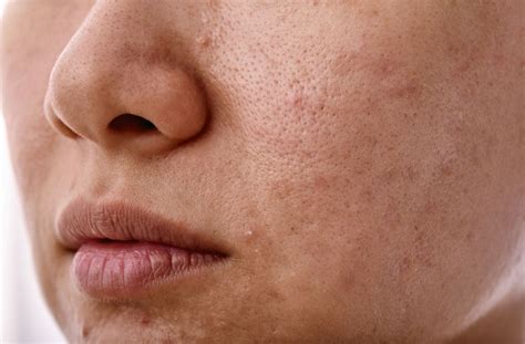 Sebum: Definition, Causes, and Remedies - Soteri Skin