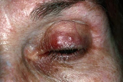 Ocular Rosacea - Causes, Triggers, Symptoms, Eye Drops, Treatment