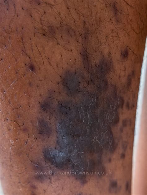 Kaposi Sarcoma — Black & brown skin