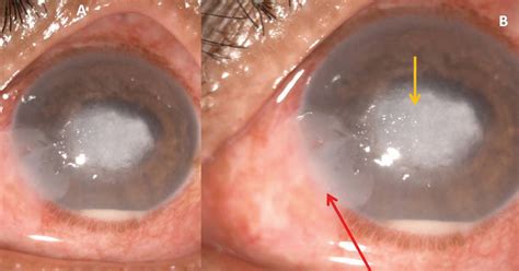 Ulcer On Eye Fungal Corneal Ulcer After Repair Of An Overhanging