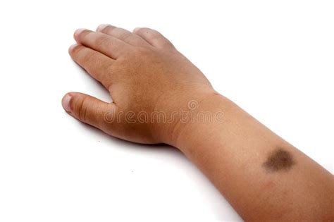 Birth Mark on the Right Hand Stock Photo - Image of mark, birth: 51368406