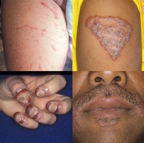 What is an allergic skin reaction? – Crutchfield Dermatology