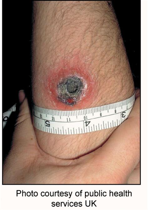 Cutaneous anthrax - Pictures