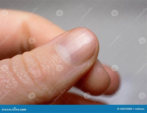 Psoriasis Hypothyroidism Stock Photos - Free & Royalty-Free Stock ...