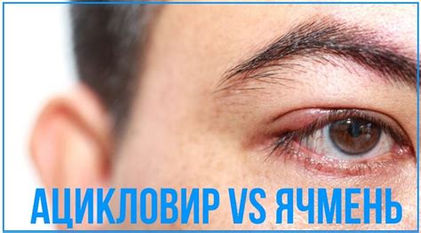Ацикловир при ячмене на глазу: мазь и таблетки, эффективность ...