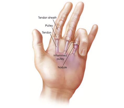Trigger finger endoscopic treatment | Montreal, Toronto, Ottawa, Gatineau