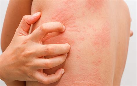 Stress Rash - Causes, Symptoms, Treatments & Tips – SkinKraft