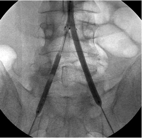 Leriche Syndrome: Percutaneous Treatment with Mechanical Thrombectomy ...