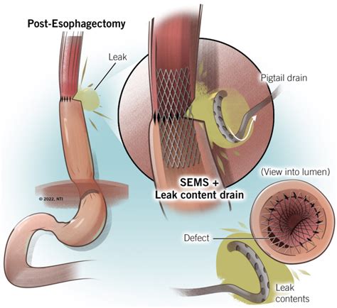 techniques   management  esophageal anastomotic leaks