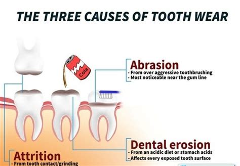 Idyll Dental: 3 Common Causes of Tooth Wear