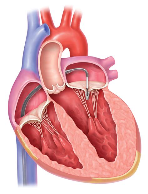 Mitral Valve: Common Diseases and Treatments | Froedtert & MCW