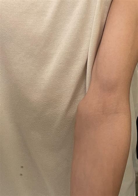 Why are my arms this skinny? I tend to eat a lot but I can’t gain any