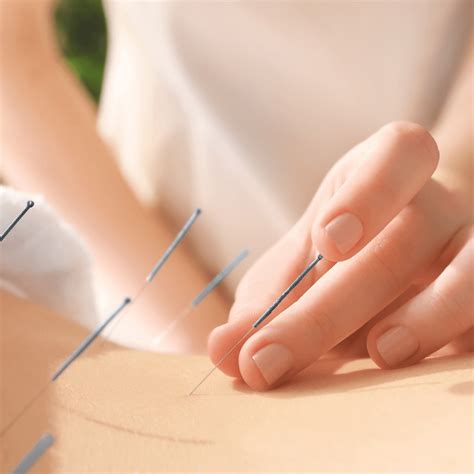 The Ultimate Guide To Acupuncture - Natural Solutions