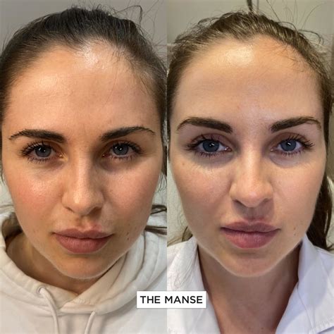 Brow Lift Before And After - Before After