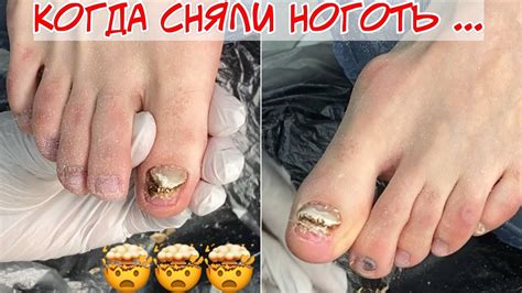 Онихолизис на ногах, отслоение ногтей на пальцах 😱 Почему пришлось ...