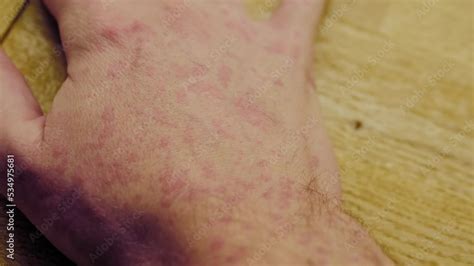 Food Allergy, Lot of red spots or rash on the skin all of a man hand body, allergic to weather ...