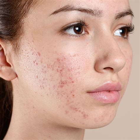 Acne and Acne Scarring Treatments | Face Teeth Smile | Gerrards Cross