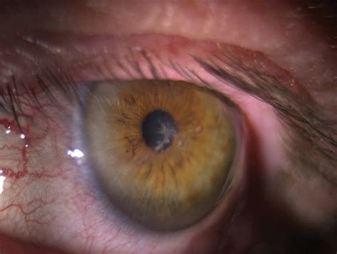 Dendritic Corneal Ulcer