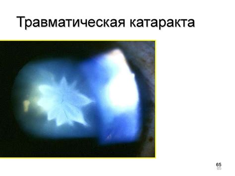 Сестринский уход при заболеваниях хрусталика - презентация онлайн