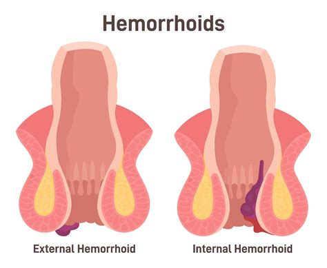 how to fix internal hemorrhoids