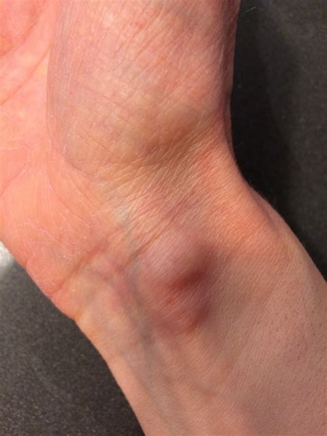 painful bump  wrist tendon ganglion cyst   wrist  hand thnpoq
