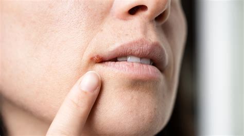 cold sore  throat