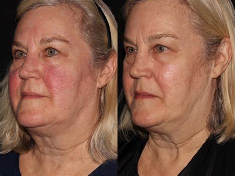 BBL™ PhotoFacial Before and After Pictures Case 5 | Chico, Yuba City ...