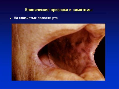 Надпочечниковая недостаточность - презентация онлайн