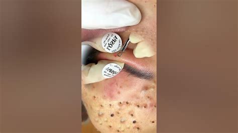 Unbelievable Blackhead Removal – So Deep and Satisfying! 😳 - YouTube