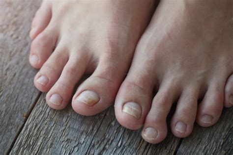 Fixing a Cracked, Broken, or Split Toenail | Red Mountain Footcare