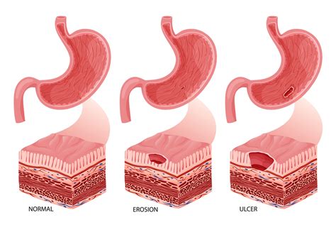 Stomach erosion and ulcer development illustration 36362506 Vector Art ...
