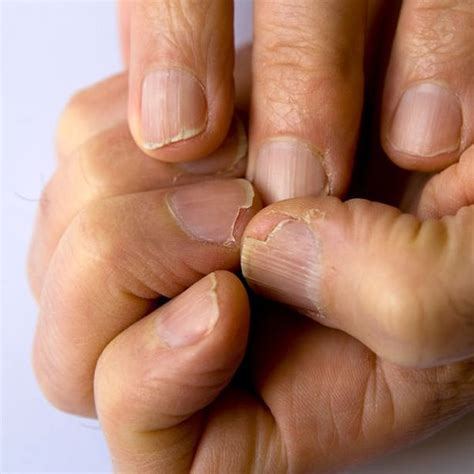 How to Easily and Safely Treat Nail Psoriasis: Nail-Care Tips – ND ...