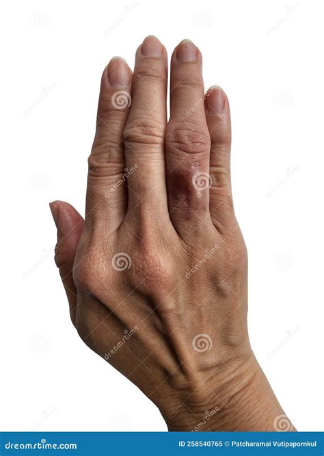 Surgical Wound on Fingers from Stitching and Dismantling Stock Image