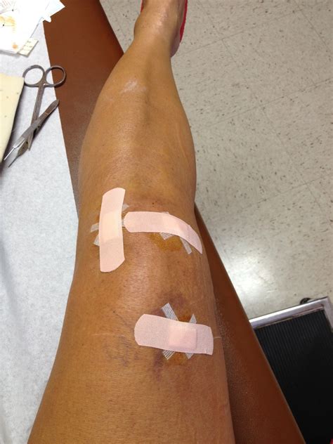 Yay-Toast: another day in the life of me...: RECOVERY- STITCHES REMOVED
