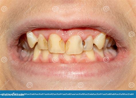 dentes podres carie  close  da chapa asocially um paciente  mal