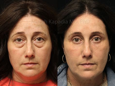 Before and two weeks after upper blepharoplasty surgery | Boston Eyelid