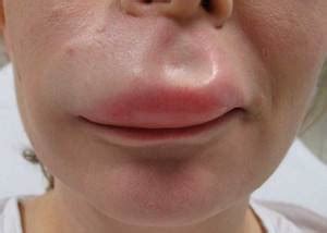 Quincke's edema: what it looks like, first aid at home