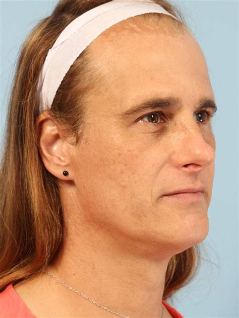 Before & After Facial Feminization Surgery Bellaire | Face Forward